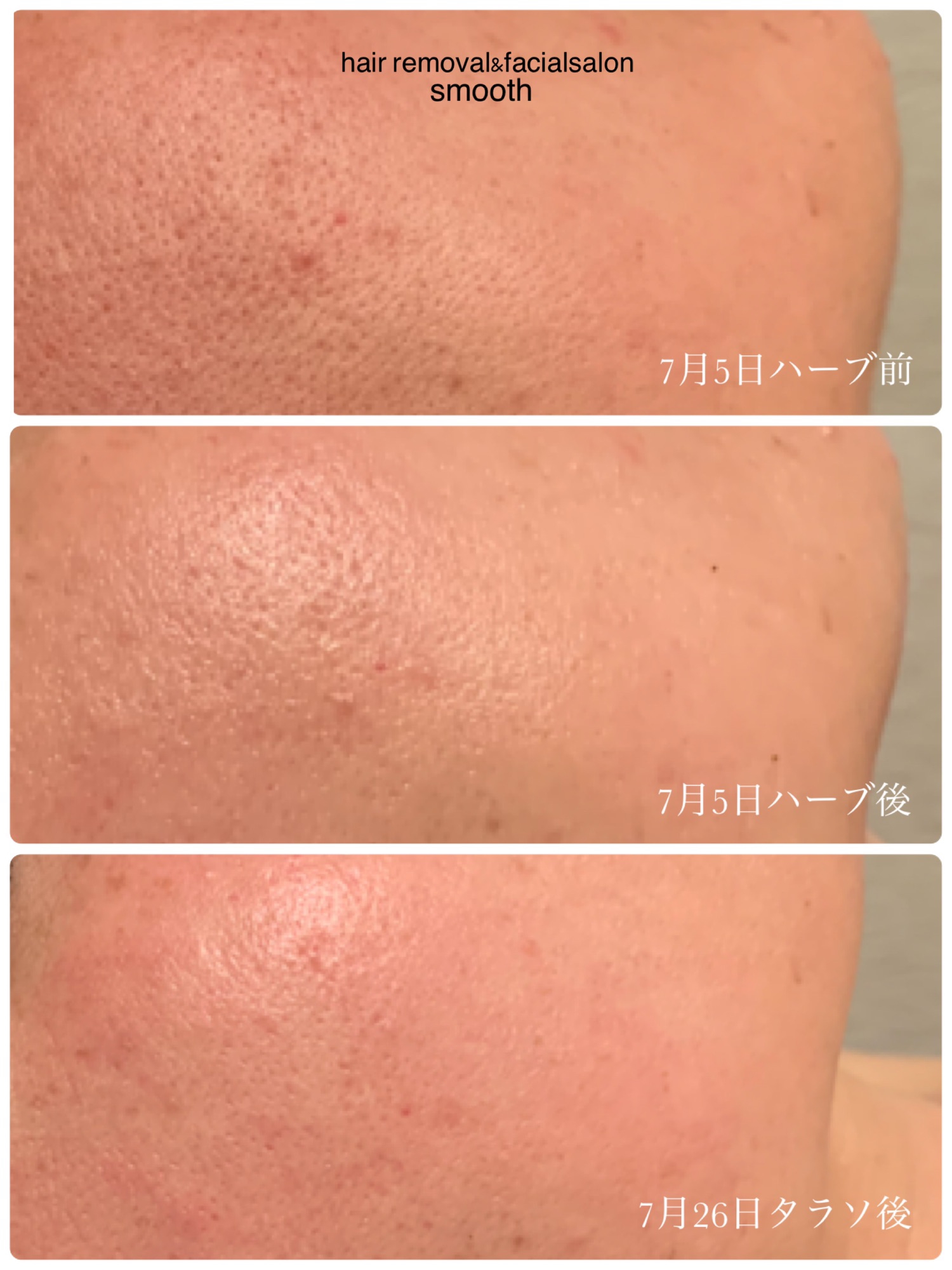 リアボーテハーブトリートメントの凄さ。 | hair removal&facialsalon