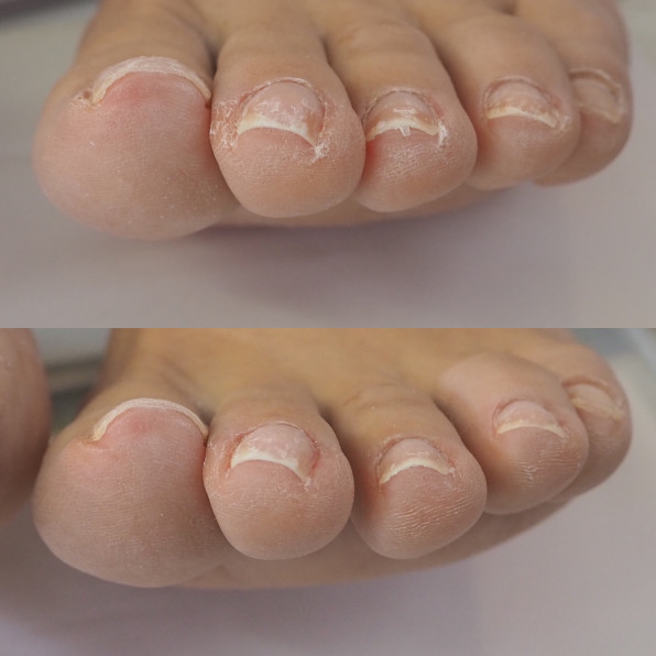 爪周りの角質ケア Rnk 爪屋