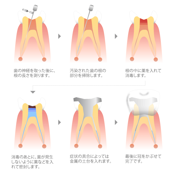 治療回数 根管治療 足立区竹ノ塚 インビザライン 透明マウスピース矯正 専用サイト 稲葉歯科医院