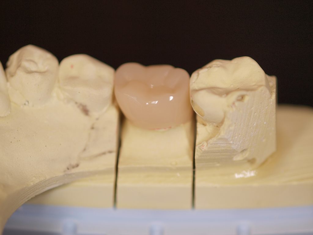 【CAD/CAM冠について】 | 足立区竹ノ塚 インビザライン（透明マウスピース矯正）専用サイト 稲葉歯科医院