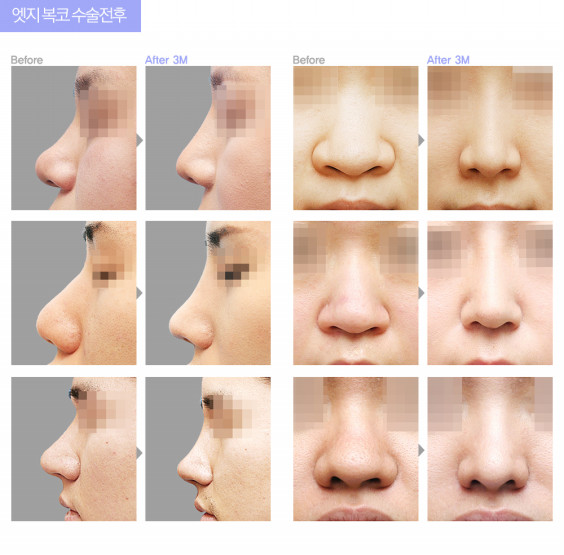 鼻の整形はどれくらい種類があるのか Wonjin Beauty Medical Group 鼻の整形はどれくらい種類があるのか Wonjin Beauty Medical Group