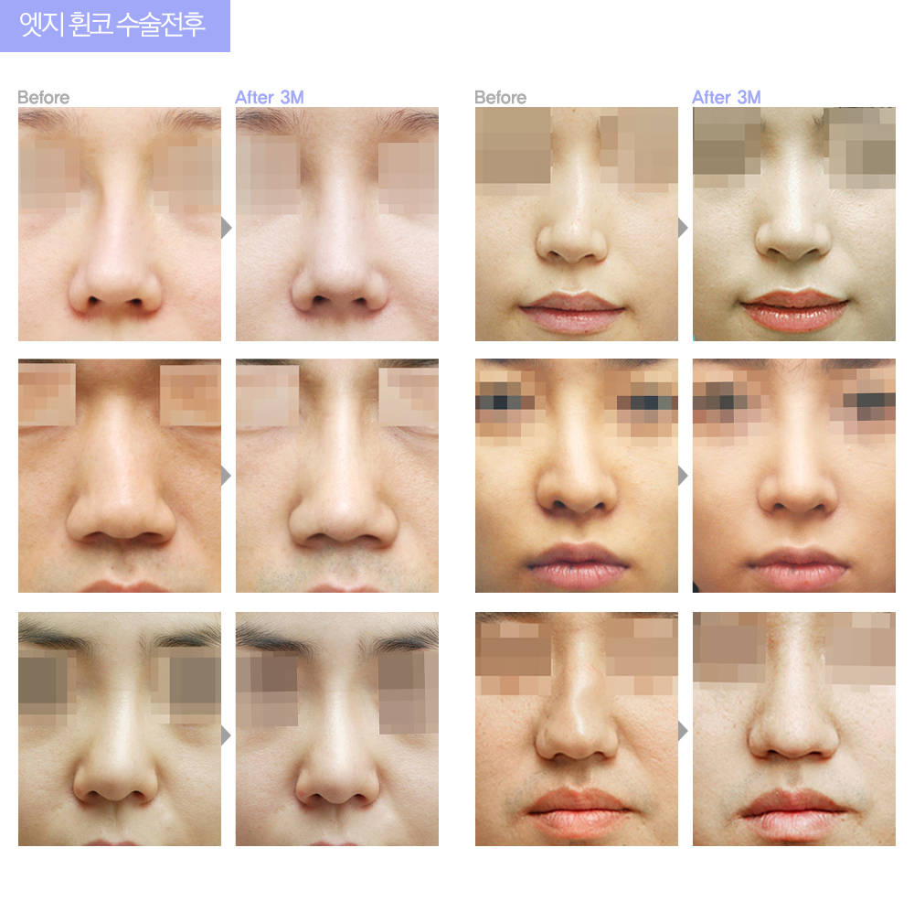 鼻の整形はどれくらい種類があるのか 2 Wonjin Beauty Medical Group