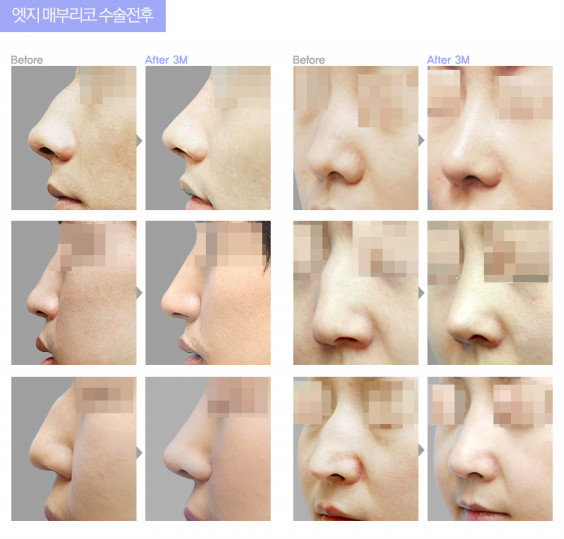 鼻の整形はどれくらい種類があるのか Wonjin Beauty Medical Group