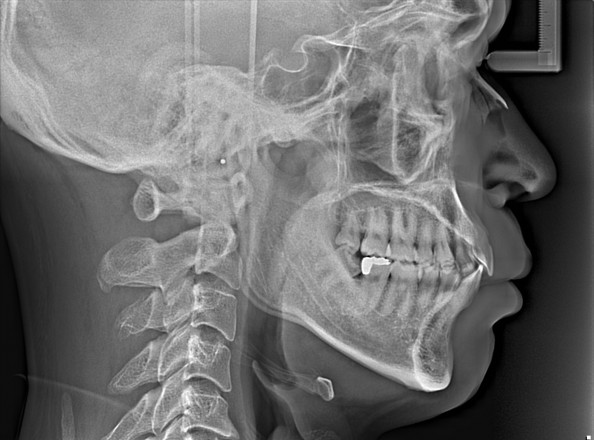 パノラマx線写真と頭部x線規格写真 セファロ は必須 正しい歯並び かみ合わせを手に入れましょう