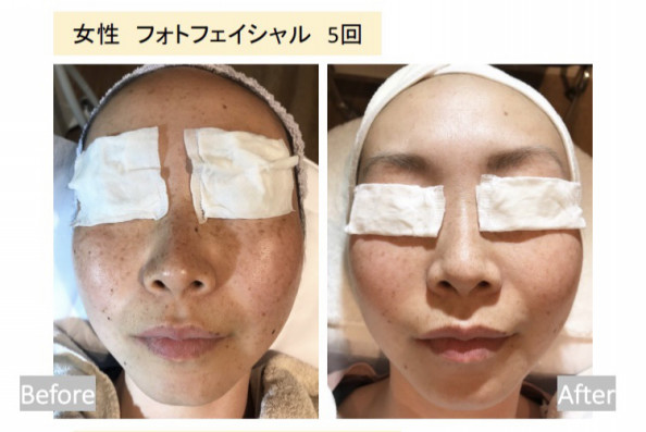光フェイシャルリフトup 宮古島 極上の癒し空間 トータルビューティーサロン Lino Beauty リノビューティ 光フェイシャルリフトup 宮古島 極上の癒し空間 トータルビューティーサロン Lino Beauty リノビューティ