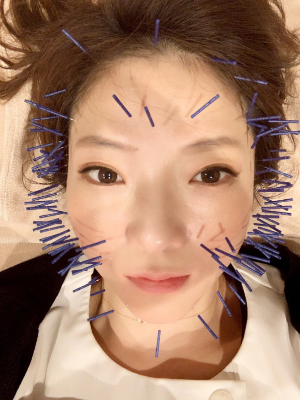 Liftalの美容鍼100本コース 葛飾区立石駅のトータル鍼灸ケア ー リフトアップ美容鍼灸サロン Liftal リフタル Liftalの美容鍼100本コース 葛飾区立石駅のトータル鍼灸ケア ー リフトアップ美容鍼灸サロン Liftal リフタル
