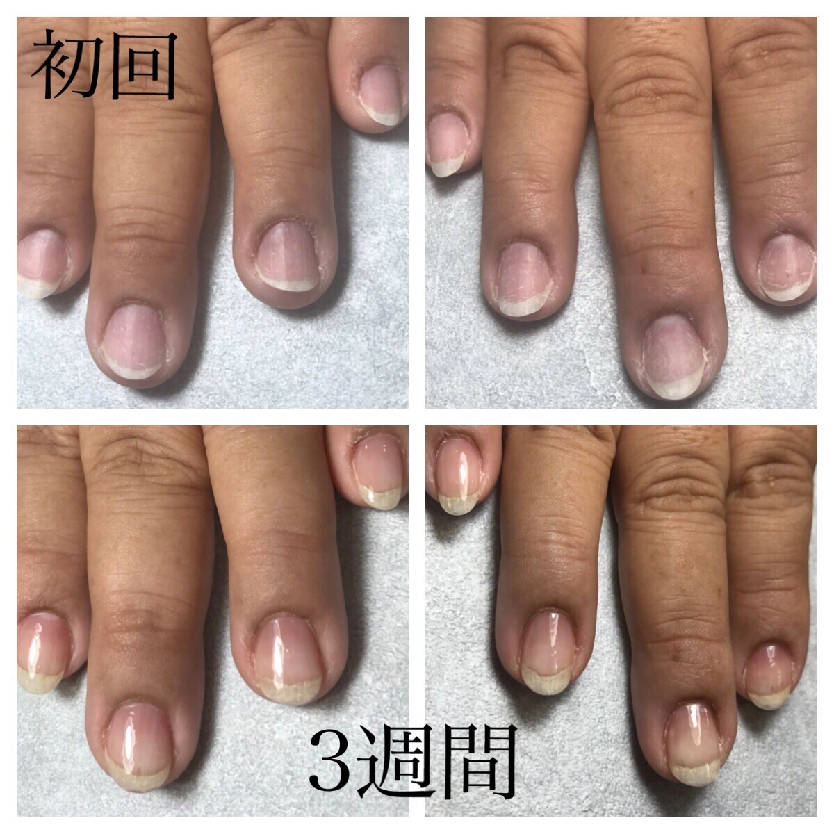 自爪育成って何 爪が変わる Fruitful Nail