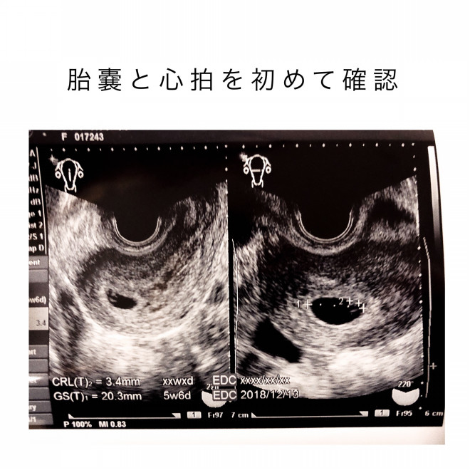 妊娠初期の急成長 エコー写真 Chii Room