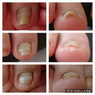 こどもの足の爪がボロボロなんです Nail A Che ネイル アーチェ