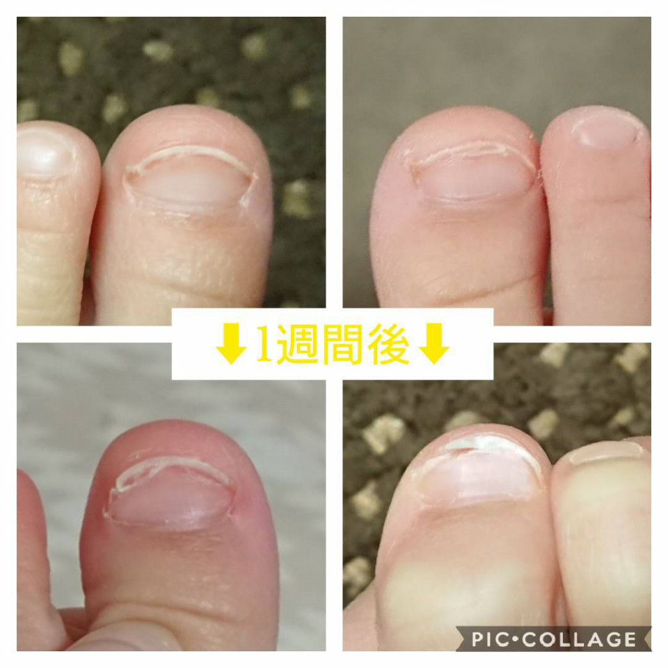 こどもの足の爪がボロボロなんです Nail A Che ネイル アーチェ