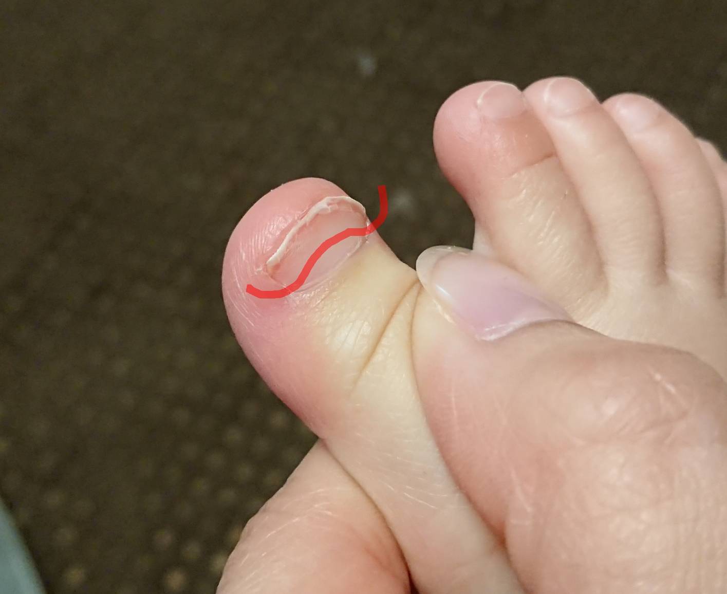 上向きに伸びる足の爪