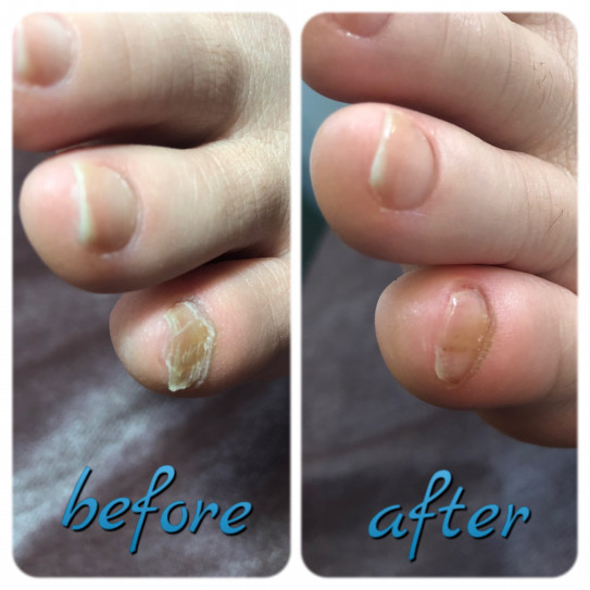 悩んでいた小指の爪 松本市 フットケアサロン First Penguin