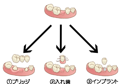 SAFE 欠損補綴設計 長期治療計画 インプラント 補綴•技工的併合証 SAFE 欠損補綴設計 長期治療計画 インプラント 補綴•技工的併合