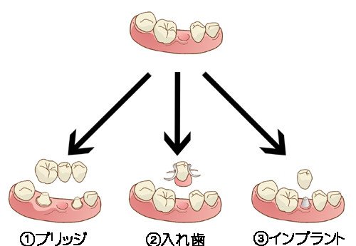 歯が無くなったところに歯を入れたい 欠損補綴 公式 吉武歯科医院 長崎市の歯科医院