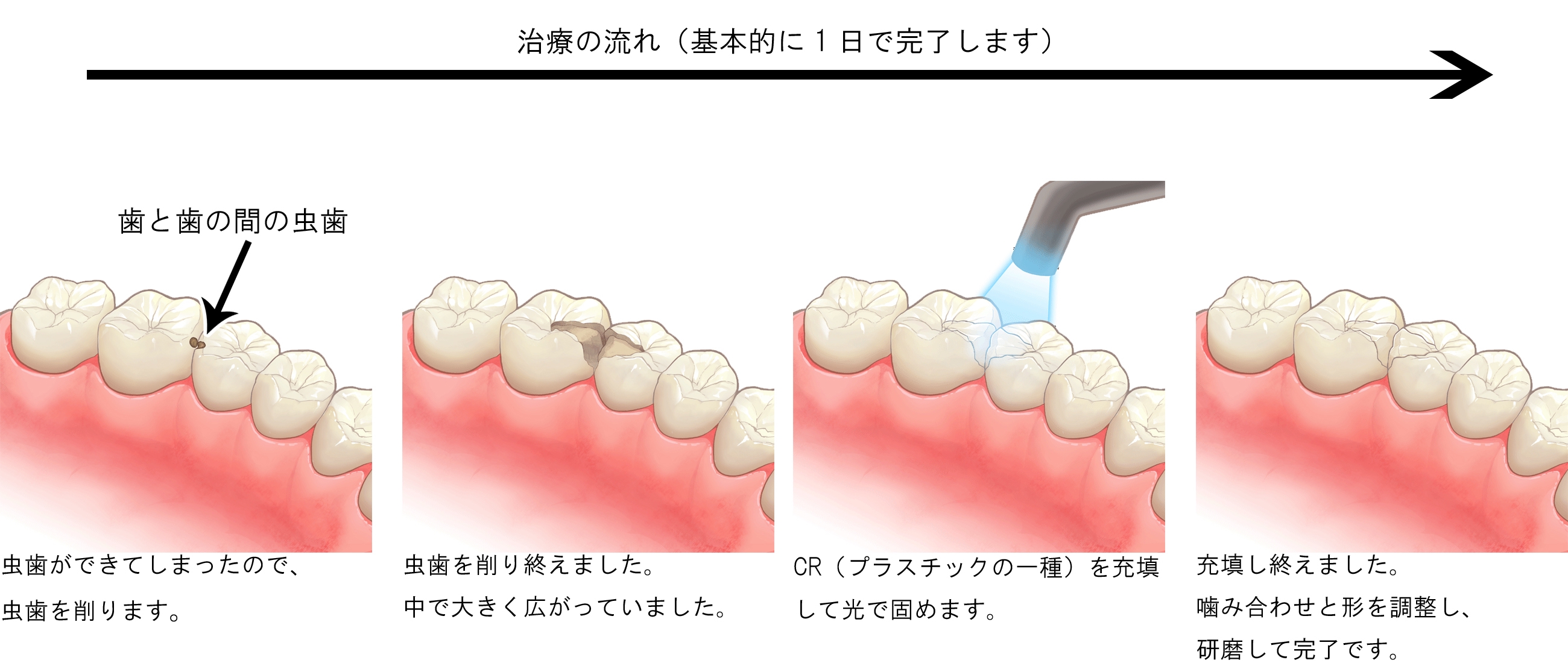 歯に虫歯ができた（虫歯の治療）  【公式】吉武歯科医院｜長崎市の 