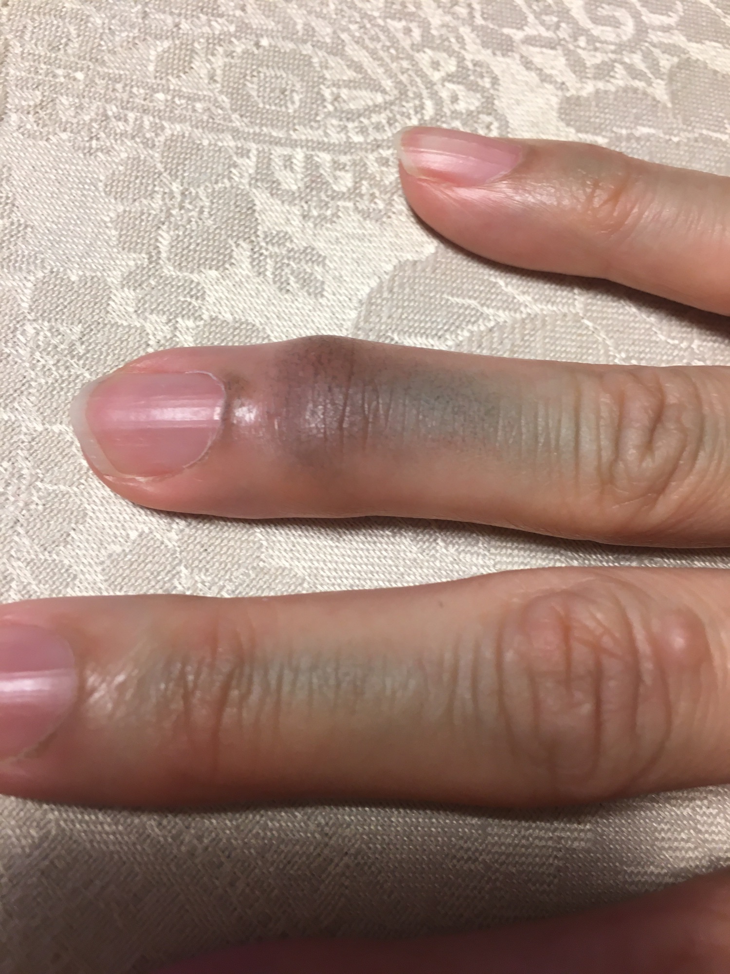 ヘパーデン結節の錆 Cs60豊中crea