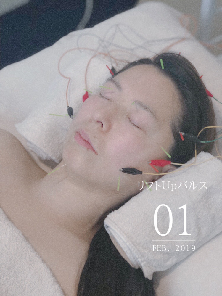 鍼灸】【美顔鍼】パルス売ります