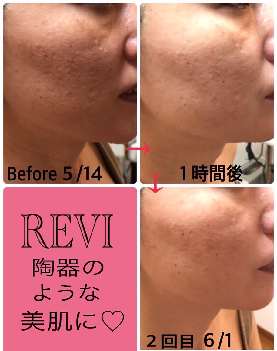 REVI 陶肌トリートメント（＋エンザイム＆シルクパウダー）2回分の+