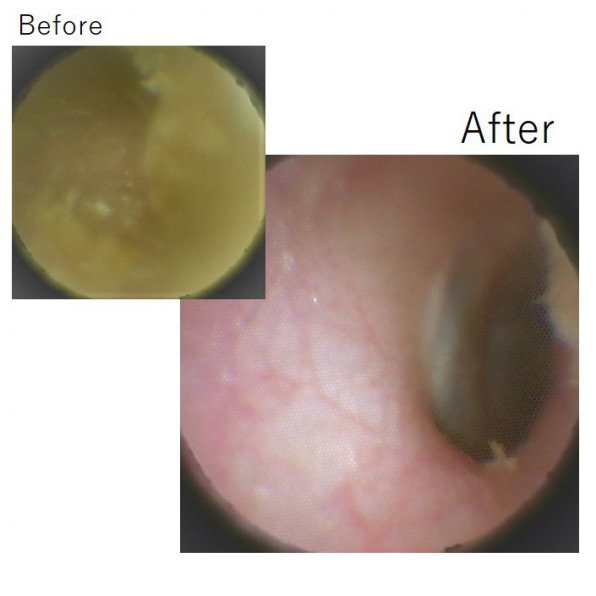 大きな耳垢でふさがっていたお客様 施術事例 Mimi専科 見える耳掃除サロン みみせんか Jeb認定イヤーエステサロン