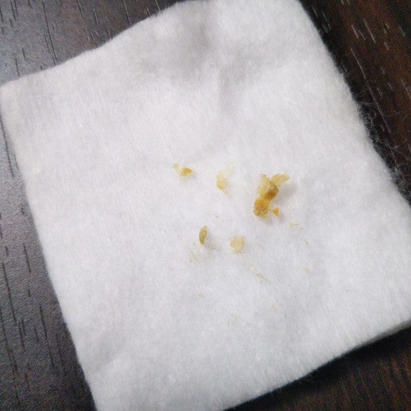 大きな耳垢でふさがっていたお客様 施術事例 Mimi専科 見える耳掃除サロン みみせんか Jeb認定イヤーエステサロン 大きな耳垢でふさがっていたお客様 施術事例 Mimi専科 見える耳掃除サロン みみせんか Jeb認定イヤーエステサロン