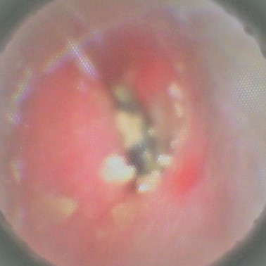 生活で使える耳つぼ 花粉症編 Mimi専科 見える耳掃除サロン みみせんか Jeb認定イヤーエステサロン