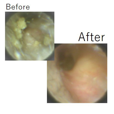 耳掃除しなかったらどうなる 3ヶ月でこれだけ溜まりました Mimi専科 見える耳掃除サロン みみせんか Jeb認定イヤーエステサロン