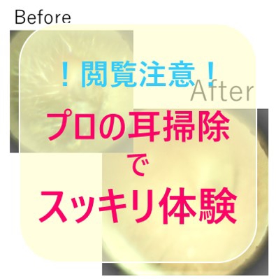 耳そうじ・耳かき施術事例～イヤホンで押し込んでしまった耳垢