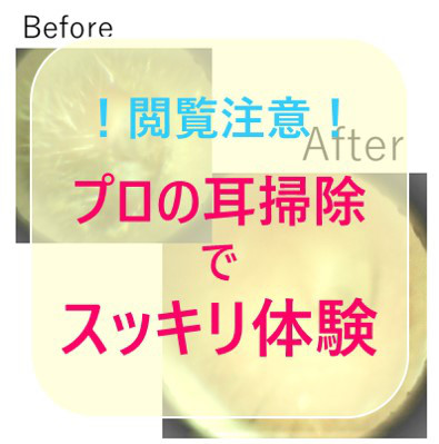 耳そうじ 耳かき施術事例 イヤホンで押し込んでしまった耳垢 Mimi専科 見える耳掃除サロン みみせんか Jeb認定イヤーエステサロン