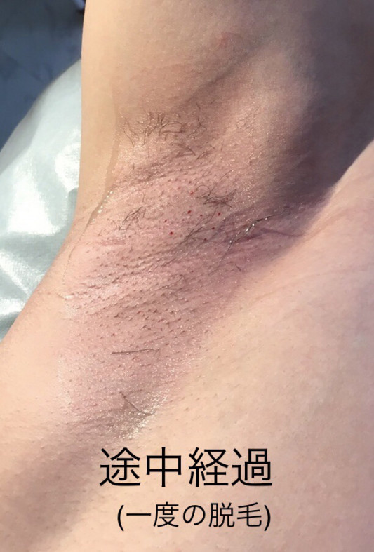 メンズ脇脱毛 Beforeafter Laugh ラフ Waxing Relaxtion