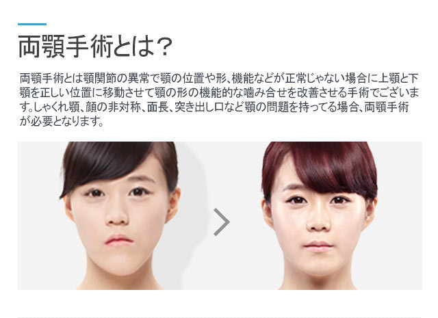 Id美容整形外科でのノータイ両顎手術 韓国整形ブログ 韓国輪郭形成15泊無料サポート Www Navi Kr Com