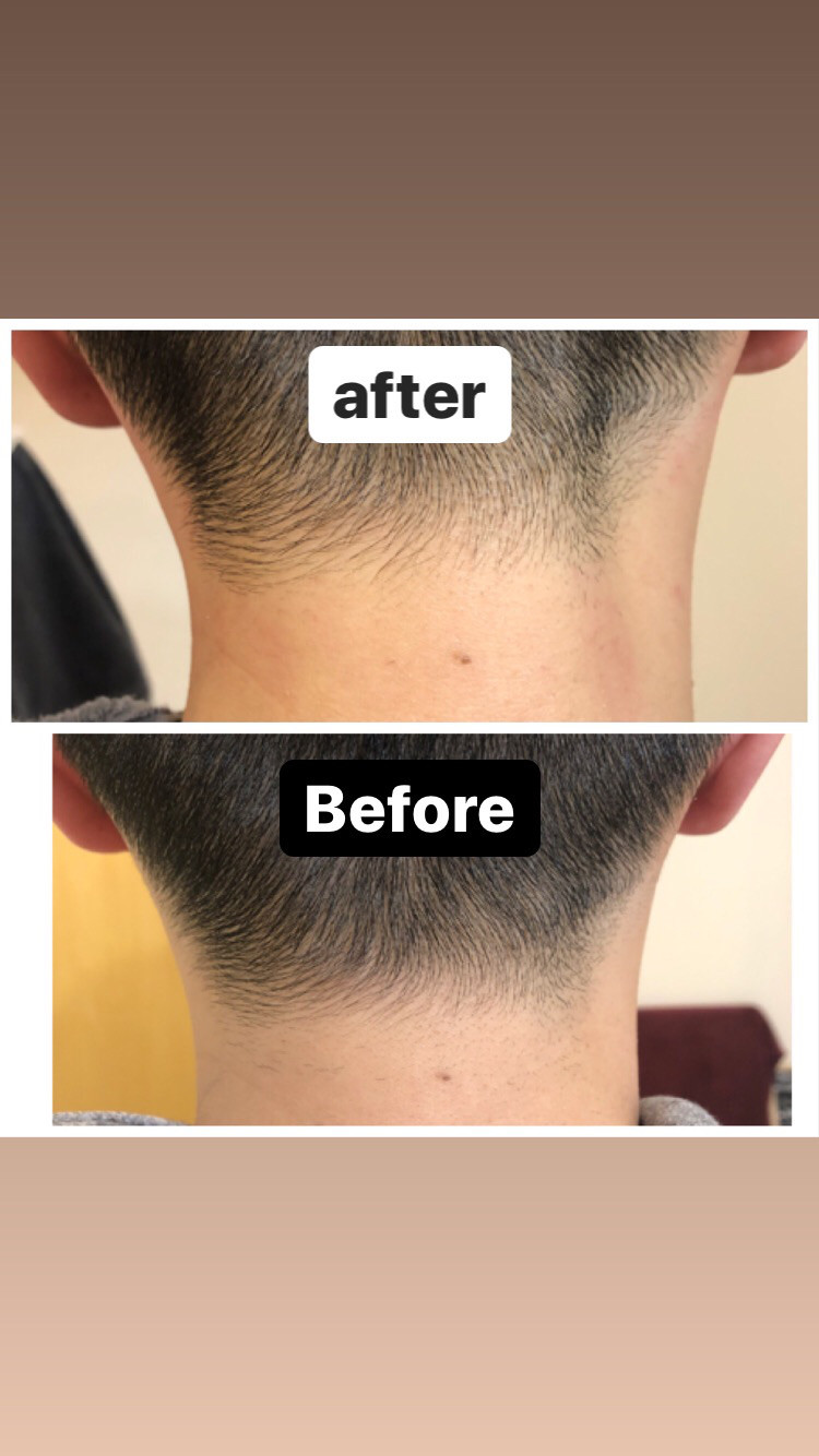 メンズワックス脱毛うなじ Colorer