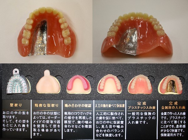 より快適に～金属床のご案内～ | 第二兒玉歯科医院 2nd KODAMA DENTAL CLINIC / 北久里浜にある歯医者