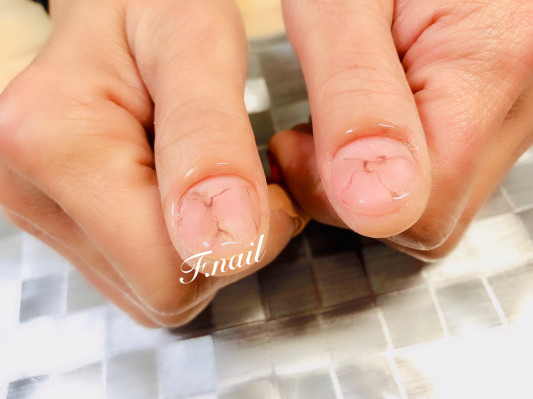 スプーンネイル矯正 堺市中区深阪自宅ネイルサロン F Nail