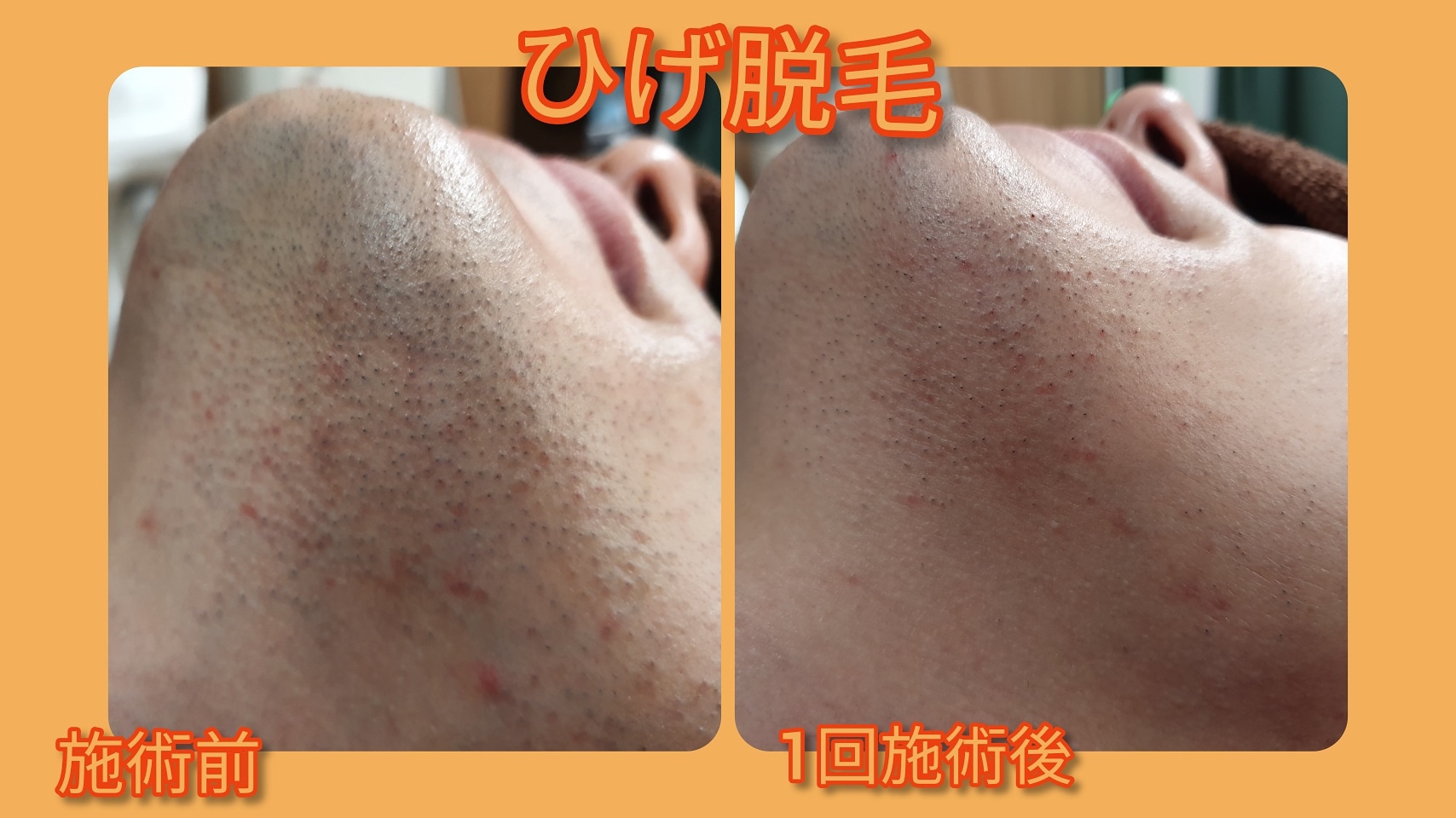 ひげ脱毛ビフォーアフター🔥 | 名古屋男性脱毛 メンズ脱毛 ...