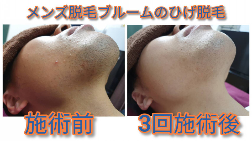 ひげ脱毛3回施術後のビフォーアフター 名古屋男性脱毛 メンズ脱毛ブルーム 金山店丨1回目から効果抜群ひげ脱毛 毎日のひげ剃りから解放 ひげ脱毛3回施術後のビフォーアフター 名古屋男性脱毛 メンズ脱毛ブルーム 金山店丨1回目から効果抜群ひげ脱毛 毎日のひげ剃りから解放