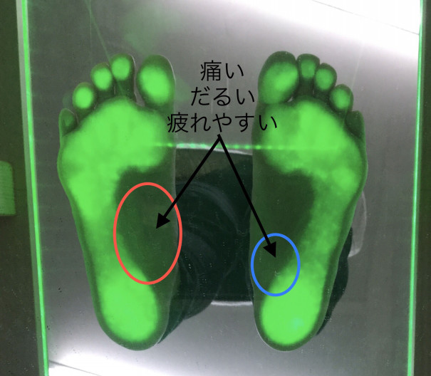 足底筋膜炎の原因 土踏まず 踵の少し前の痛み Fit Insole