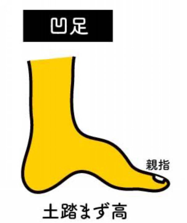 足底筋膜炎の原因 土踏まず 踵の少し前の痛み Fit Insole 足底筋膜炎の原因 土踏まず 踵の少し前の痛み Fit Insole