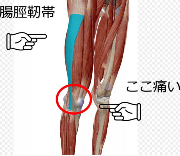 膝の外側の痛み 腸脛靭帯炎 Fit Insole