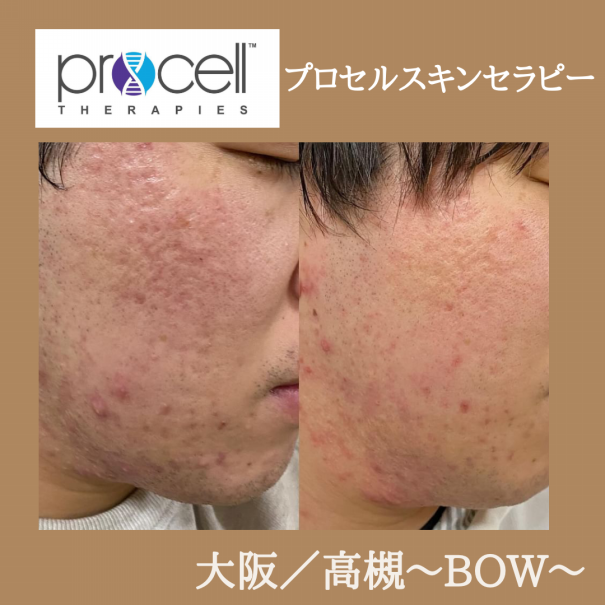 プロセルセラピーズ ProCell Therapies Japan - プロセルセラピーズ ジャパン