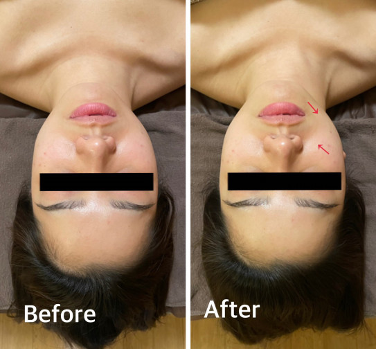 ハイパーナイフ 小顔矯正 小顔 美容矯正 リンパケア 痩身 Tsukuba 小顔