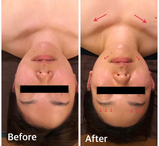 小顔矯正60分 オイル付 ハイパーナイフ分 小顔 美容矯正 リンパケア 痩身 Tsukuba 小顔