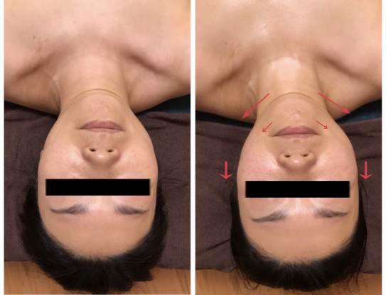 小顔矯正60分 オイル付 ハイパーナイフ分 小顔 美容矯正 リンパケア 痩身 Tsukuba 小顔