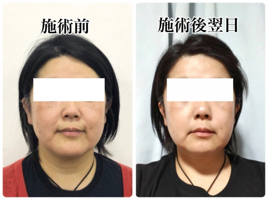 宇都宮市 40代 むくみがたるみになる前に無痛小顔矯正 栃木 小山市 痛くない安全長持ちの小顔矯正の若返り専門サロン クリヴィア Clivia 宇都宮市 40代 むくみがたるみになる前に無痛小顔矯正 栃木 小山市 痛くない安全長持ちの小顔矯正の若返り専門サロン クリヴィア Clivia