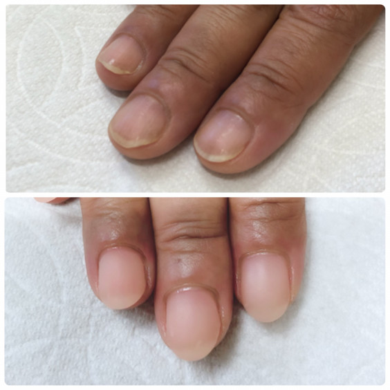 深爪ケア 初めてのネイルサロン ４ヶ月の変化 深爪のお悩みから 自信の持てる指先へ