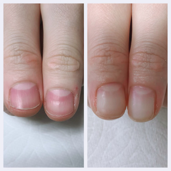 深爪ケアについて 深爪のお悩みから 自信の持てる指先へ