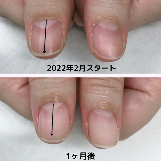 深爪ケア スタートから1ヶ月後の計画 三鷹市新川の深爪専門ネイルサロン スクール 深爪のお悩みから 自信の持てる指先へ