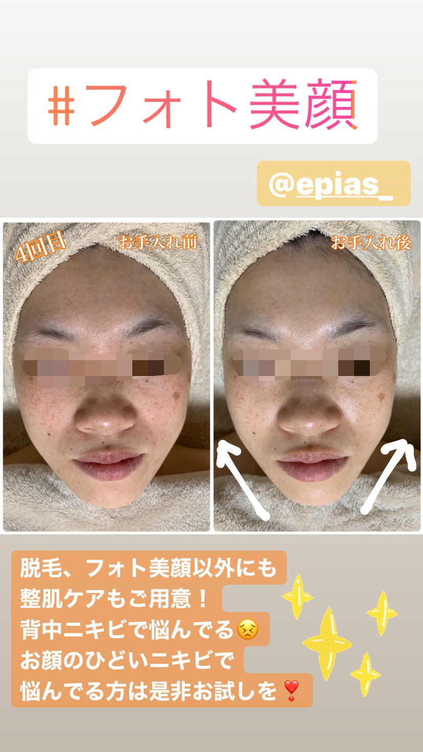 大人気 フォト美顔 女性専門美肌脱毛サロンepiasエピアス