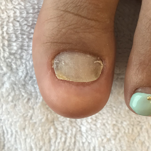 ヘルス爪ケア トラブル爪ケア 厚みがあって爪がなかなか伸びてこない 長岡市ネイルサロンnailroom Naily ネイリー Nailroom Naily