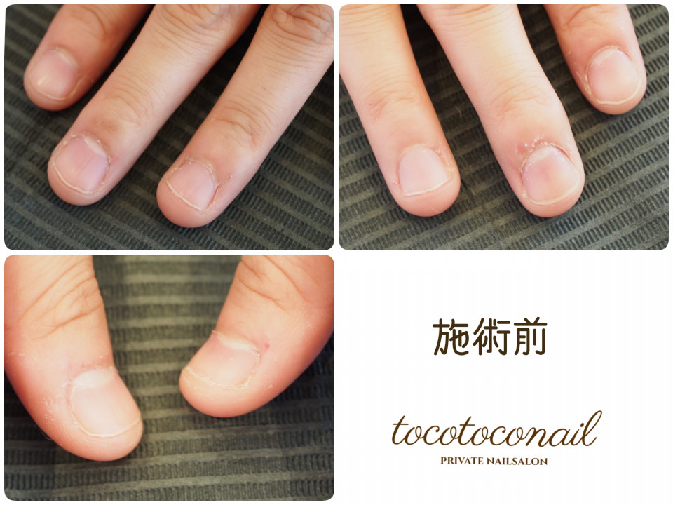 お爪にお悩みのあるお客様 Tocotoco Nail