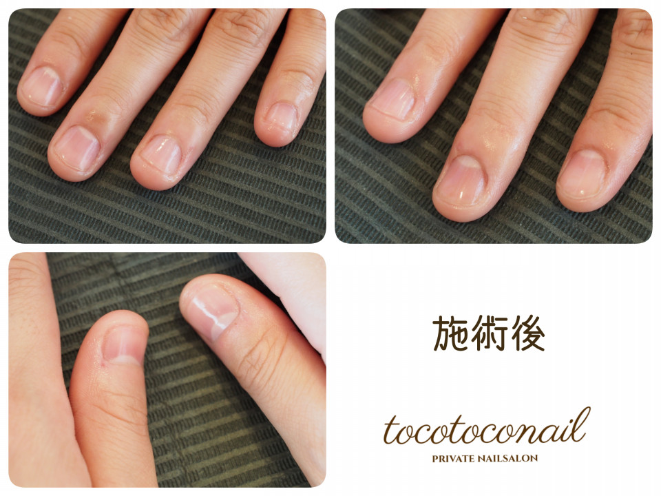 お爪にお悩みのあるお客様 Tocotoco Nail